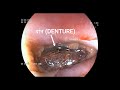 गलती से नकली दांत निगलने के वजह से हुआ इतना बड़ा घाव | Accidently ingestion of foreign body (Denture)
