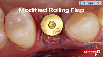 Discover the Modified Rolling Flap Technique for Dental Implants on Denpedia. #SoftTissueManagement
