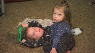 Parents Fought to Save Conjoined Twin Girls