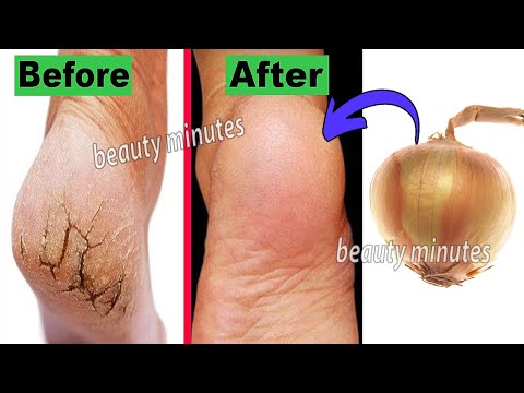 How to get rid of cracked feet in just one week and get soft feet