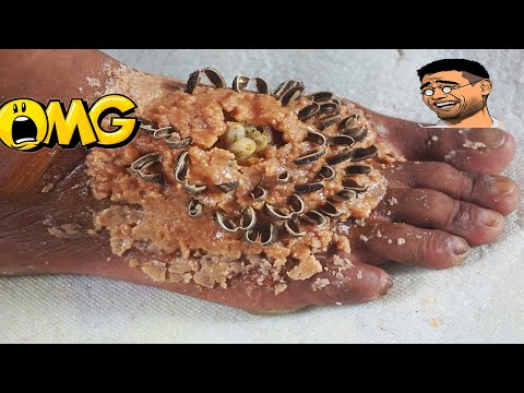 [ Worms Feet ] How To Remove Worms On Dandruff Feet #305