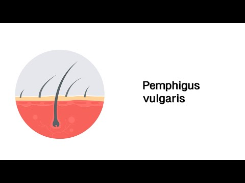 Video: Pemphigus Vulgaris: Ursache, Typen Und Symptome