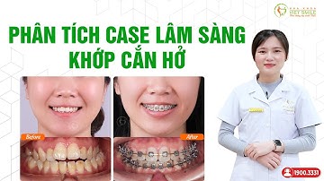 Sự thay đổi khi niềng răng khớp cắn hở - Phân tích case lâm sàng