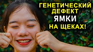 ГЕНЕТИЧЕСКИЙ ДЕФЕКТ   ЯМКИ НА ЩЕКАХ!