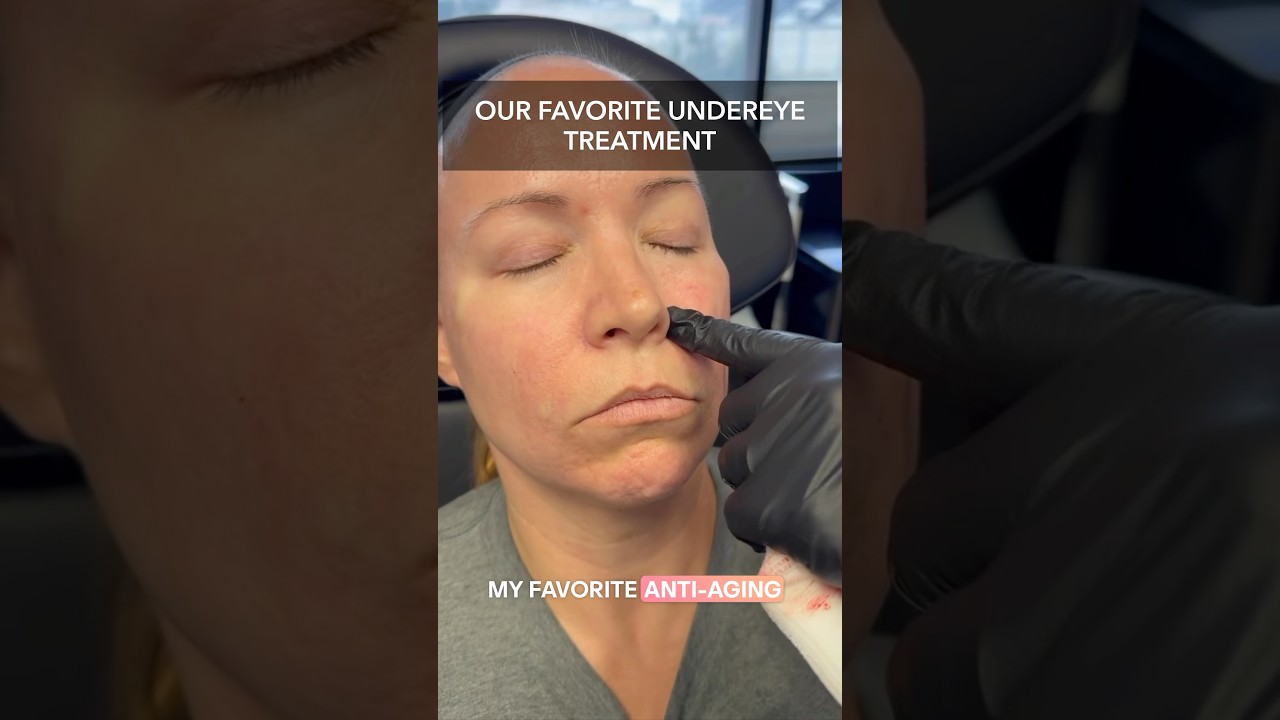 A Clean Approach To Fillers 