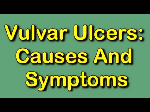 Video: Ulcers Vulva: Symtom, Orsaker, Diagnos, Behandling Och Mer