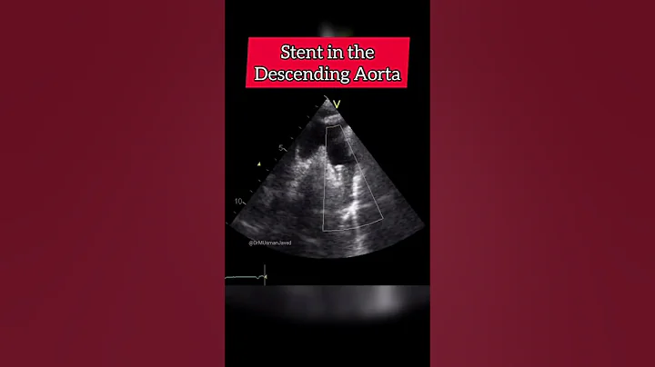 Stent in the Descending Aorta on Echocardiogram #echocardiography #cardiology #echo