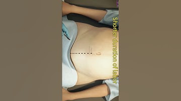 Normal Delivery or C-Section || What is the Best Option? #shorts