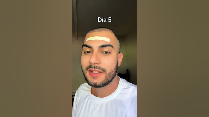 Proceso de 6 meses del trasplante capilar de Eduardo Fernández 🤠💙 #injertocapilar