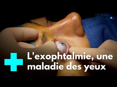 Vidéo: Yeux Exorbités: Causes, Diagnostic Et Traitements