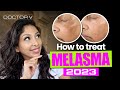 HOW TO TREAT MELASMA
