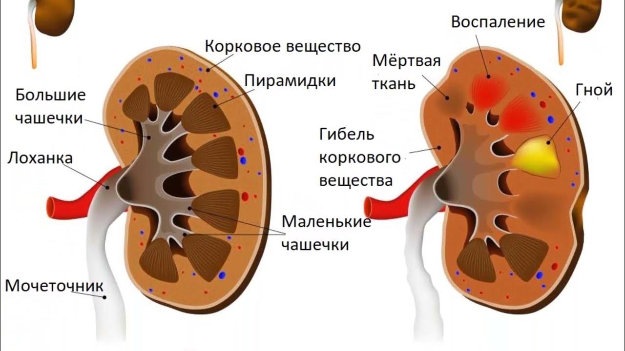 Воспаление почек пиелонефрит. Что такое пиелонефрит почек лоханки. Почка пораженная пиелонефритом. Строение почки пиелонефрит. Здоровая и нездоровая почка.