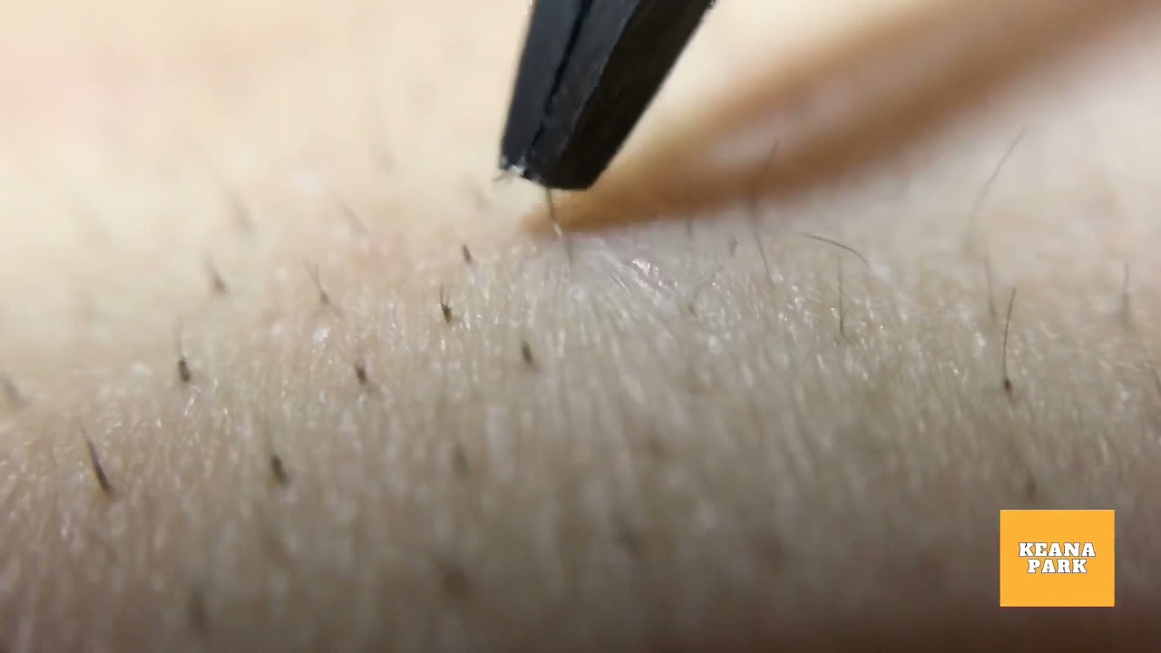 角 栓 背中