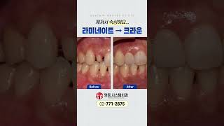 라미네이트 깨짐 어떤 치료를 받을 수 있을까요? [명동 시스템치과]