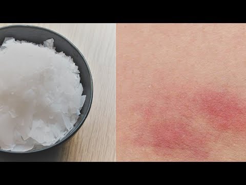 Video: Si të shpëtoni nga njollat e bardha në lëkurë për shkak të helmimit nga dielli
