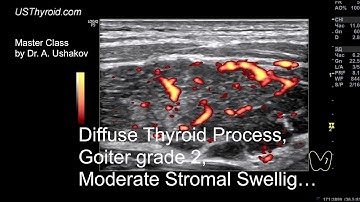 Thyroid Ultrasound.  Diffuse Process, Goiter grade 2; Hypothyroidism // Master Class by Dr. Ushakov
