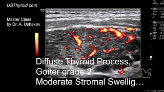 Thyroid Ultrasound.  Diffuse Process, Goiter grade 2; Hypothyroidism \/\/ Master Class by Dr. Ushakov