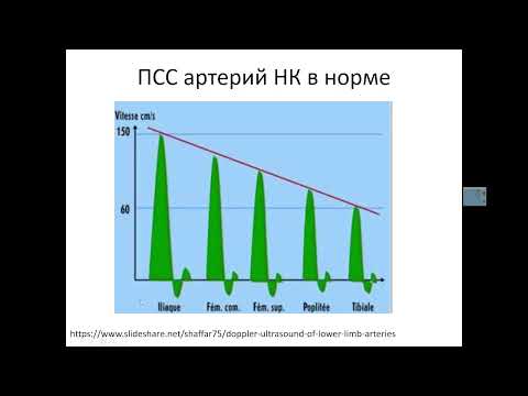 УЗДГ артерий НК.  Часть 1.  Характеристика допплеровского спектра артерий нижней конечности.