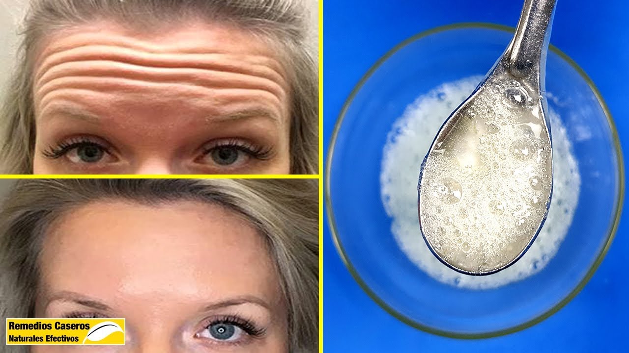 Como Quitar Las Arrugas De La Frente Con Botox Las Arrugas En La Frente Se Aparecen Mucho || Aplicar Esta Mezcla Para