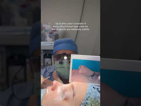 Video thumbnail: Immediate post-op rhinoplasty results | Anthony Bared MD, FACS | Miami, FL · Dr. Anthony Bared, M.D - Facial Plastic Surgeon