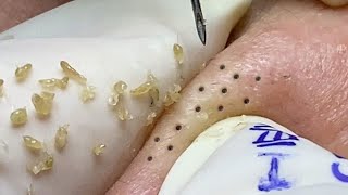 BLACKHEADS AND CYSTIC ACNE REMOVAL ON MAN'S FACE #029