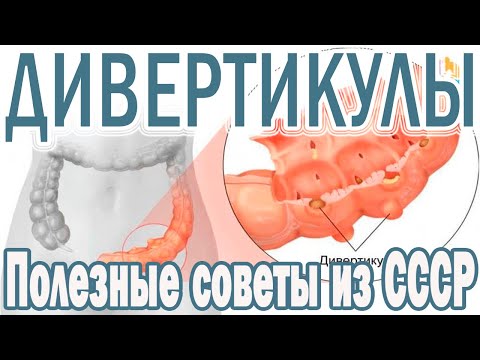 Видео: Дивертикулоза на сигмоидното дебело черво - симптоми, лечение, диета