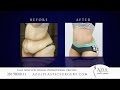 Houston tummy tuck after weight loss at azul plastic surgery sugar land woodlands tx