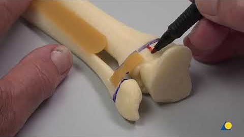 Distal Tibia —Triplane Fracture Fixation