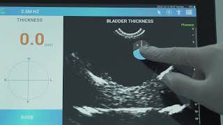 07 BladderView M5 Measure Bladder Wall Thickness
