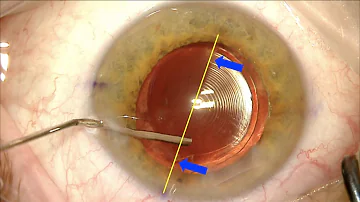 Quanto custa uma lente multifocal para catarata?
