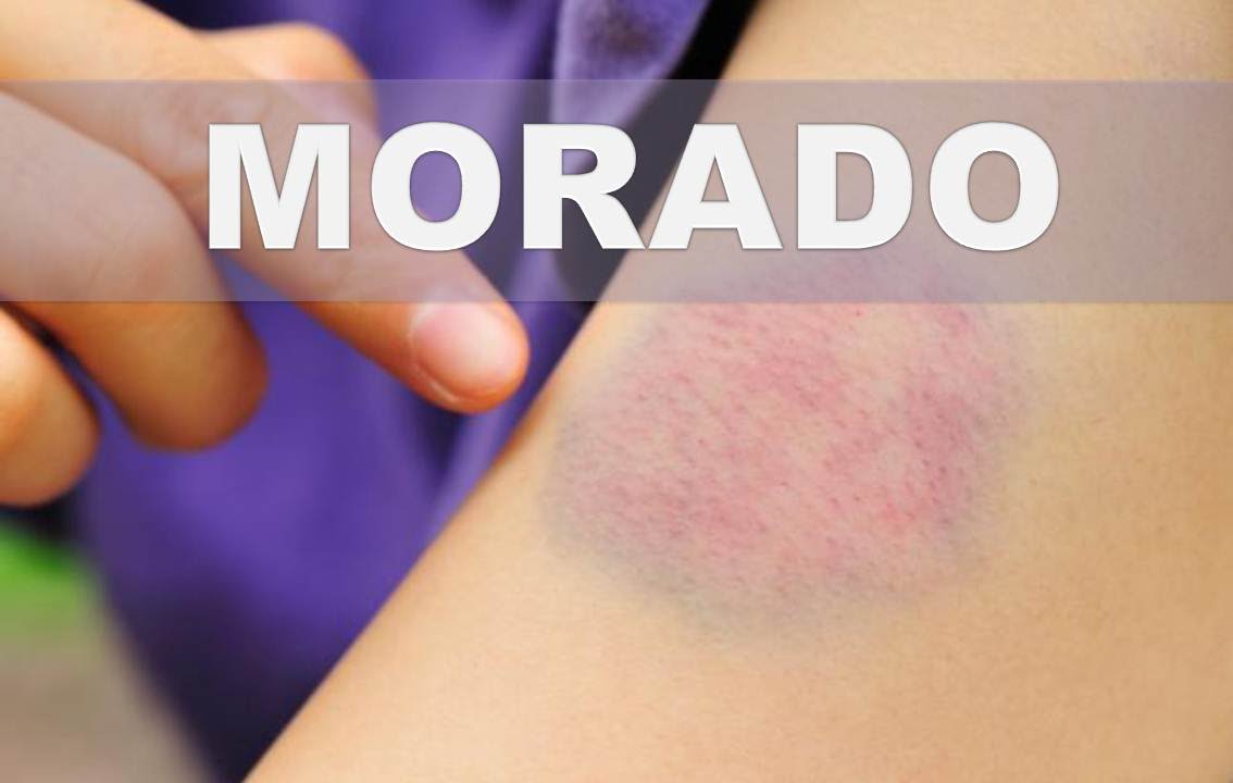☞Remedios caseros para los moretones o hematomas Como desaparecer los