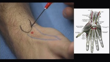 Radial Nerve- Wrist Block