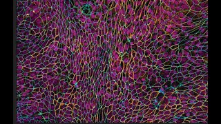 Cell jamming: Lessons in physiology from cancer cell biology.