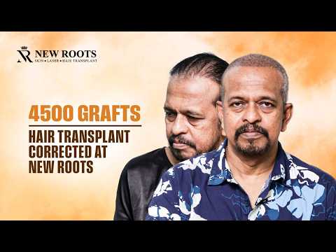 “My First Hair Transplant Didn’t Work…” 💔 | Hair Transplant in Hyderabad | Cost and Best Results