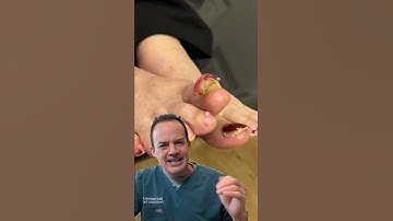 DOCTOR REACTS: WHEN YOU DON’T CUT YOUR TOENAILS! 😱 #Shorts