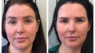 Botox Before and After