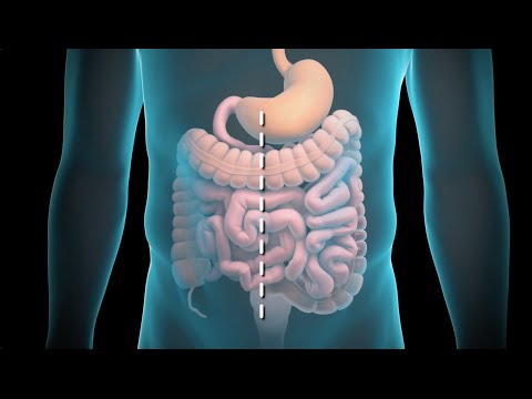 Video: Čo je resekcia čreva?