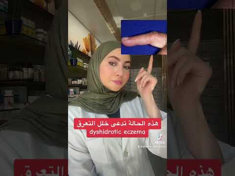خلل التعرق  