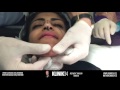 NOSEFILLER CHINFILLER CHEEKFILLER JAWLINE LIVE INJECTIONS WORKSHOP SAUDI ARABIA