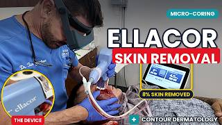 Ellacor for Acne Scars | A Closer Look at the Treatment | Contour Dermatology