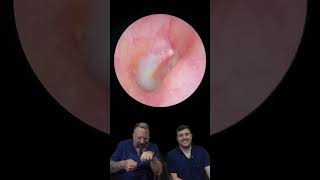 IRRIGATION OF A CHUNKY EAR WAX PLUG - EP843