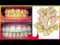 Magical Teeth Whitening Remedy, Get whiten Teeth at home in 5 minutes