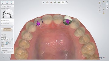 3Shape 덴탈시스템 – 임시치아 디자인 – 3Shape Dental System – Temporary Design