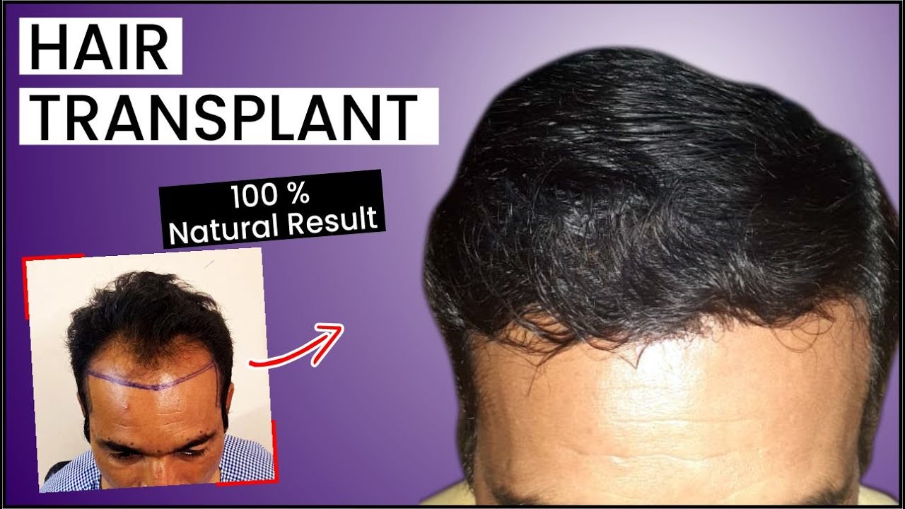 Hair Transplant After 6 Months | Hair Transplant New Technology 2020 ...