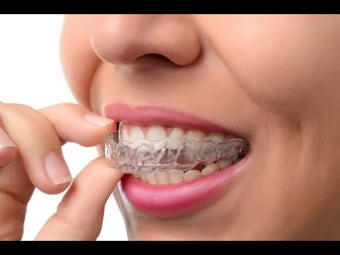 Vidéo: Qu'est-ce que les coquilles dentaires ?