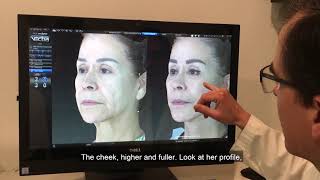 Dr. Juan Carlos Fuentes | Facelift in Tijuana | 3D simulation