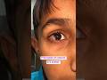 Pterygium Eye Disease 🤯#eyes #eyecareprofessional #eyedoctor #optometrist #eyespecialist #pterygium