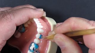 Blue View™ Matrix Techniques for Class II, III, IV, V and Diastema Closure screenshot 2