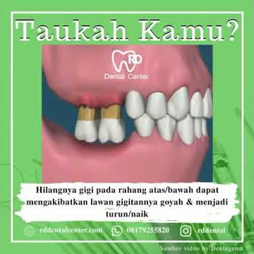 Bahaya Akibat Hilangnya Gigi Rahang Atas/Bawah