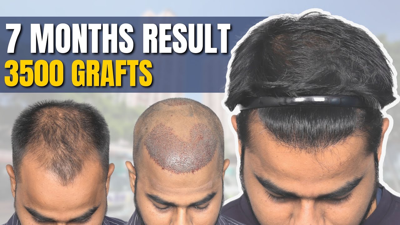 Bangladesh Hair Transplant Before After Results